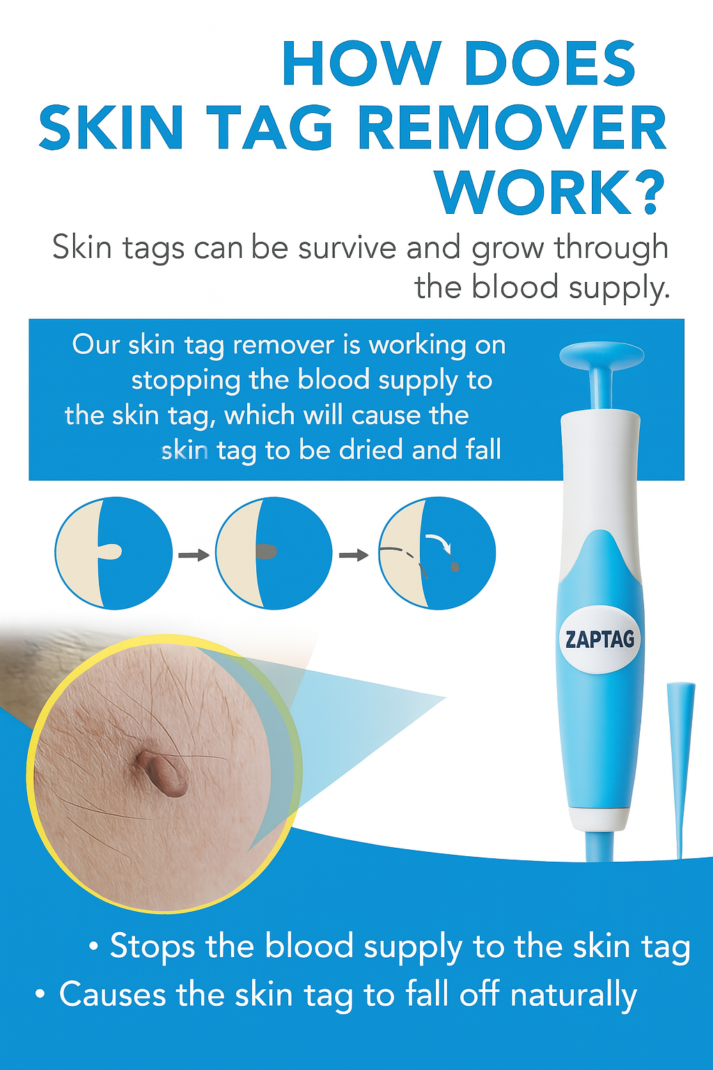 ZapTag™ Skin Tags Remover Pen