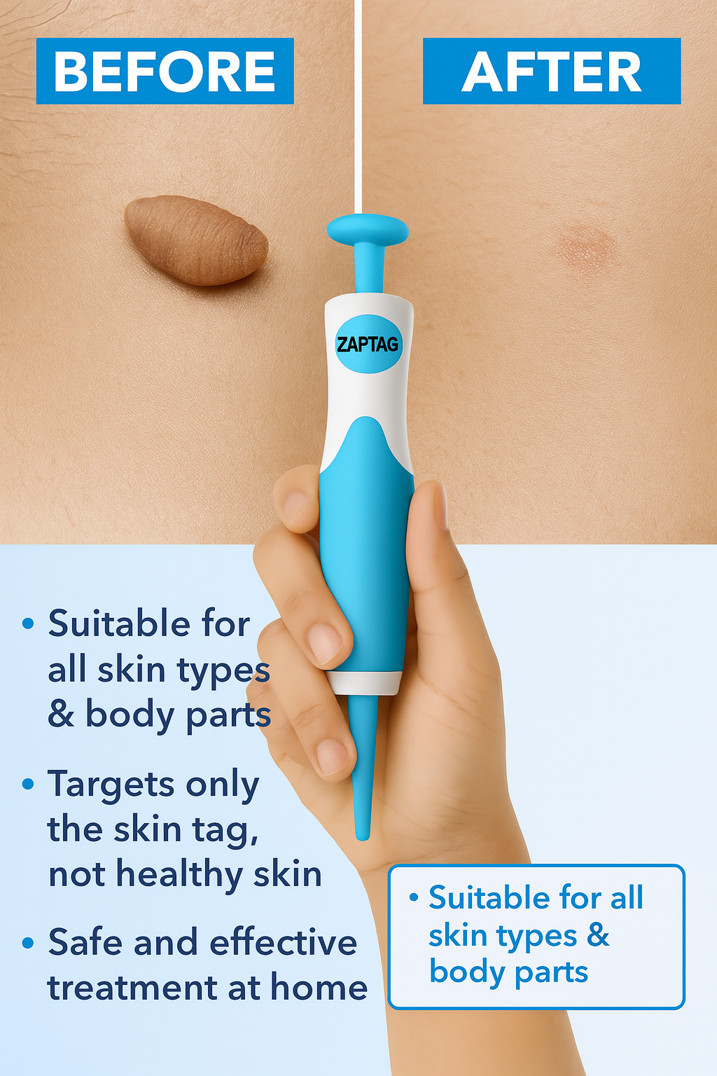 ZapTag™ Skin Tags Remover Pen